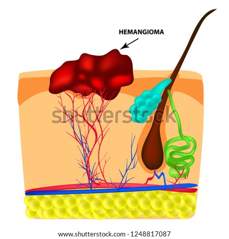 Structure Hemangeoma. The structure of the red mole on the skin. Birthmark. Infographics. Vector illustration on isolated background.