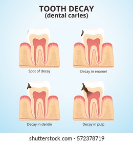 The structure of human teeth, dental disease - caries, the stage tooth decay