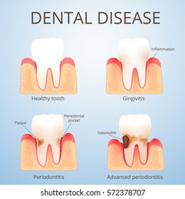 the structure of human teeth, the development of dental disease, plaque and calculus