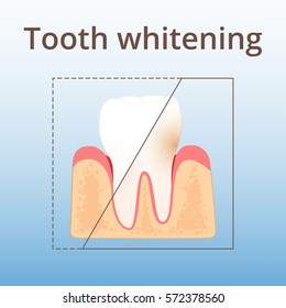 structure of human teeth, teeth whitening, plaque removal before and after