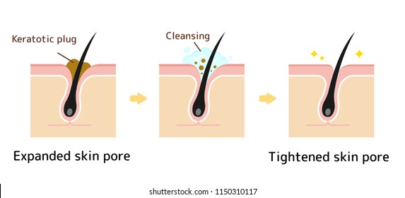 Structure illustration of pores / Clear keratotic plug (whiteheads ,blackheads ) with cleansing. 