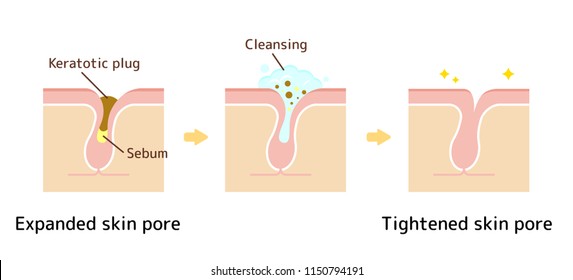 Structure illustration of pores / Clear keratotic plug (whiteheads ,blackheads ) with cleansing. 