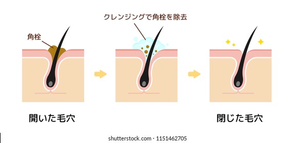 Structure illustration of pores / Clear keratotic plug (whiteheads ,blackheads ) with cleansing. Kakusen (keratotic plug) , Hiraita Keana (expanded skin pore) etc.