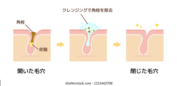 Structure illustration of pores / Clear keratotic plug (whiteheads ,blackheads ) with cleansing. Kakusen (keratotic plug) , Hiraita Keana (expanded skin pore) etc.