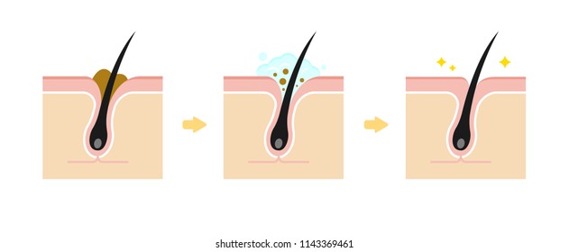 Structure illustration of pores / Clear whiteheads (blackheads) with cleansing. 