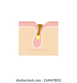 Structure illustration of pores /keratotic plug (whiteheads , blackheads) . 