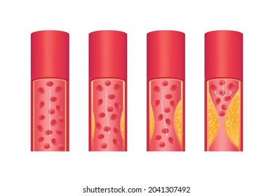 La estructura del interior de las arterias. Enfermedad de aterosclerosis.