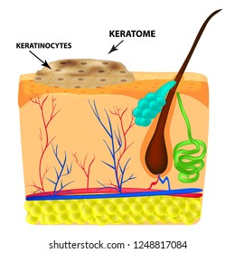 The structure of keratoma. Keratosis. The structure of moles on the skin. Infographics. Vector illustration on isolated background.