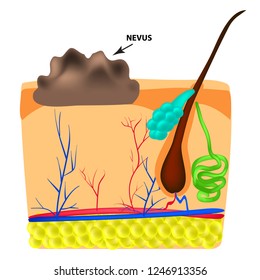 The structure of the nevus. The structure of moles on the skin. Infographics. Vector illustration on isolated background.