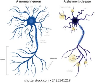 La estructura de una neurona enferma y sana. Neurona dañada. Enfermedad de Alzheimer. Enfermedad cerebral, demencia, trastornos de la memoria. Una neurona en el Alzheimer