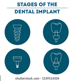 Structure of the tooth implant vector illustration flat design