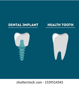 Structure of the tooth implant vector illustration flat design