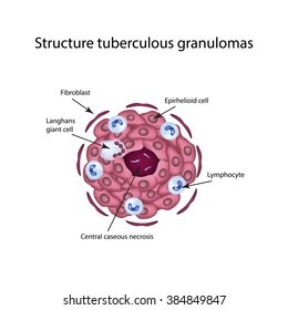 The structure of tuberculous granulomas. Infographics. Vector illustration on isolated background.