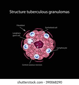 The structure of tuberculous granulomas. Infographics. Vector illustration.