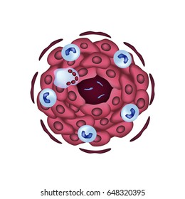 The structure of tuberculous granulomas. Infographics. Vector illustration on isolated background.