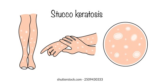 Queratose de estuque nos braços e pernas. Uma doença de pele de origem desconhecida, que se manifesta pela formação de pápulas queróticas com descamação branca prateada. Vetor médico colorido.