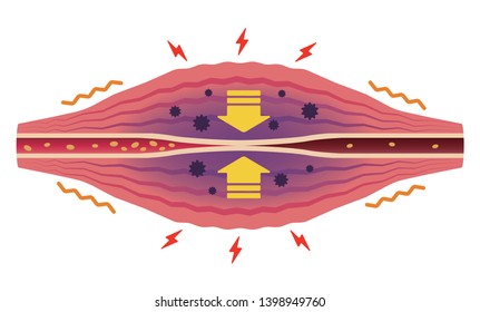 Stuffness and pain occur (no text) . Flat illustration of muscle and vessel.