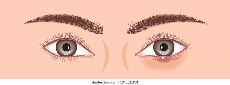 Stye Vector Illustration