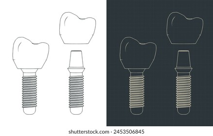 Stylized vector illustrations of blueprints of dental prosthesis