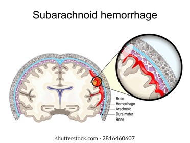 Subarachnoid hemorrhage. Bleeding between arachnoid and pia mater. Aneurysm rupture. 