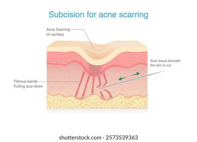 Subcision for Acne Scars treatment. Cut fibrous bands under skin layers tethered down within skin with small needle for treat. Micro surgical technique.