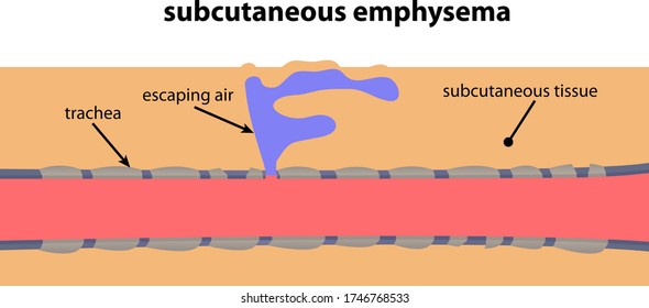pulmón de cierre de enfisema subcutáneo