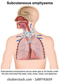 Subcutaneous Emphysema Medical Vector Illustration With English Description On White Background, Anatomy Infographic