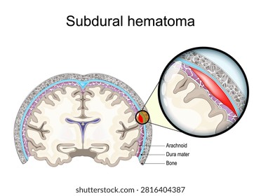 Subdural hematoma. Blood accumulation between dura mater and brain surface. Cross section of human brain. Neurology trauma. Traumatic brain injury. Types of Intracranial Hemorrhage. medical infographic diagram. Vector illustration.
