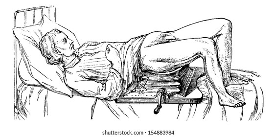 Subject operated on the device for lithotripsy, vintage engraved illustration. Usual Medicine Dictionary - Paul Labarthe - 1885.