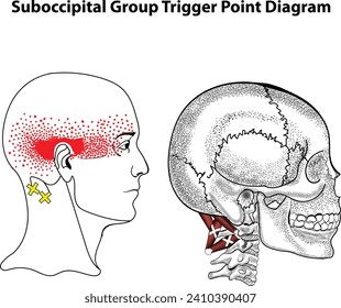 Suboccipital Group Trigger Point Diagram, trapezius, SCM, Levator, Scalenes, and Suboccipital Triangle muscle group. Suboccipital Trigger Point Release and Stretch.