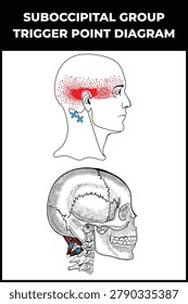Suboccipital Group Trigger Point Diagram, trapezius, SCM, Levator, Scalenes, and Suboccipital Triangle muscle group. Suboccipital Trigger Point Release and Stretch.
