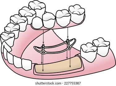 Subperiosteal implant: a saddle-shaped frame is placed on top of the jaw bone. The prosthesis is attached to the posts that protrude above the gum.