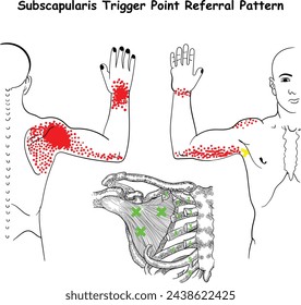 subscapularis trigger point referral pattern vector Diagram