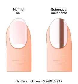 Subungual melanoma. Melanoma under nail. Close-up of a human finger with Nail bed cancer. Vector poster