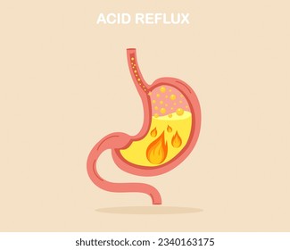 Suffering from GERD symptom with acid reflux Stomach heartburn with burning acid inside Digestive system gastritis problem.