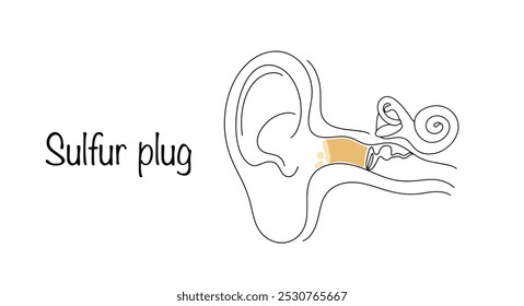 Sulfur plug. A buildup of earwax blocking the ear canal. Improper ear hygiene leading to hearing loss. Medical isolated vector.