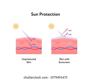 Sun protection medical infographic. Vector flat illustration. Skin layers with uva and uvb arrows. Protected with sunscreen and unprotected. Design for cosmetic industry and dermatology.