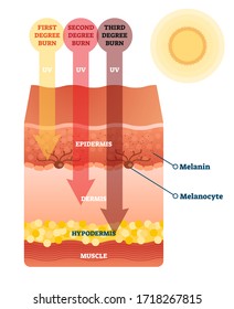 Sunburn skin damage anatomical cross section diagram. Medical problem explanation scheme. UV light impact on epidermis, dermis and hypodermis layers. Cancer risk caution and health danger awareness.