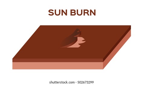 sunburn from uv until the skin peel off  vector . burn