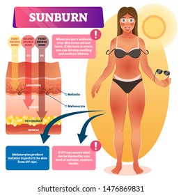 Sunburn vector illustration. Medical skin burn problem explanation scheme. Labeled diagram with UV degree impact to epidermis, dermis and hypodermis layers. Anatomical cancer risk and health danger.