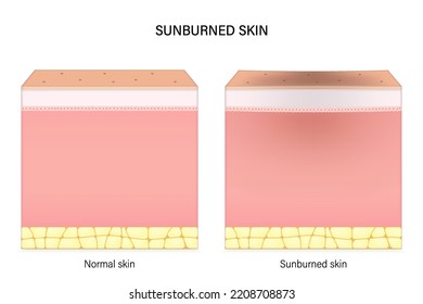 Sunburned skin. Comparison of normal skin and sunburn. Facial skin problems. Vector for advertising about beauty and medical treatment.