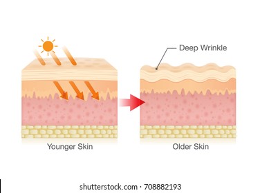 Sunlight makes sagging skin and makes it appear more wrinkled.