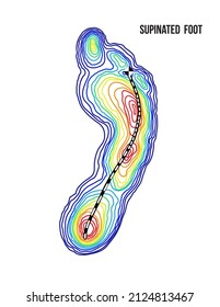 Supinated foot, arch deformation, bottom view. Foot weight distribution.