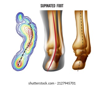 Supinated foot, arch deformation, bottom and back view . Foot weight distribution.