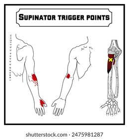 Supinator trigger points vector diagram