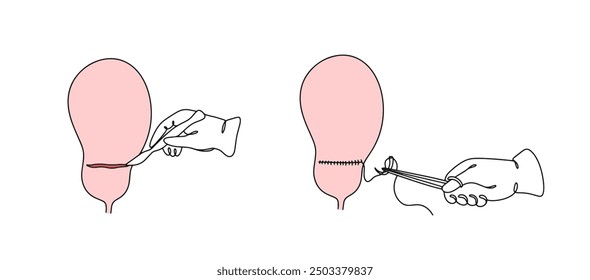 Der Chirurg macht einen Schnitt in der Gebärmutter, um das Baby zu entfernen und schließt das Organ mit einem chirurgischen Nahtmaterial. Kaiserschnitt. Farbvektorgrafik.