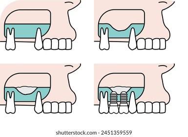 the surgery of dental implant - flat illustration 