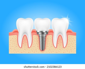 Surgery molar with tooth implant replacement in gum. For good dental healthy teeth. Screw denture orthodontic implantation. Stomatology clinic and dental implant  concept. Realistic 3D vector.