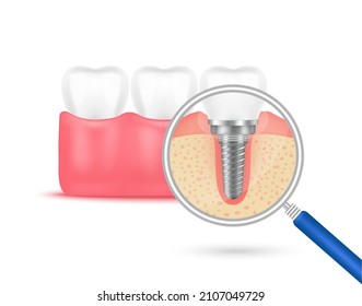 Surgery molar with tooth implant replacement in gum. For good dental healthy teeth. Screw denture orthodontic implantation. Stomatology clinic and dental implant concept. Realistic 3D vector.