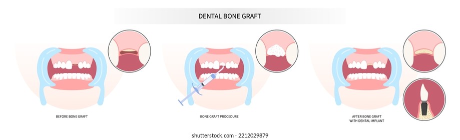 surgery of oral teeth bone graft procedure